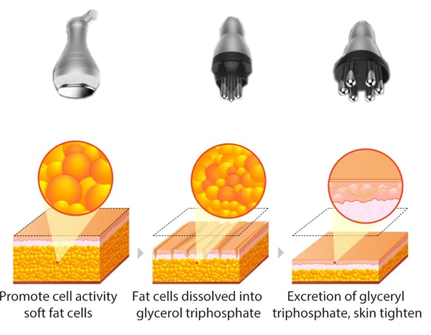 Cellulite Workstation (slimming machine) - Image 3