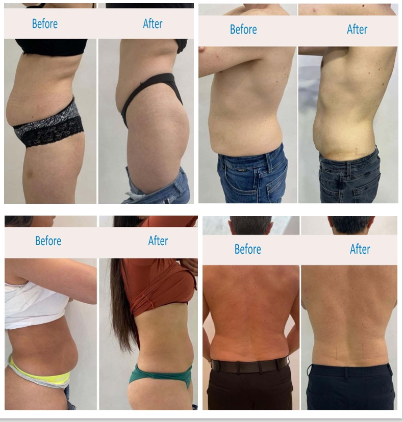 Cellulite Workstation (slimming machine) - Image 4